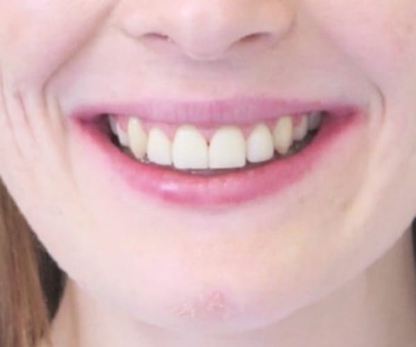 After - Lusk Orthodontics