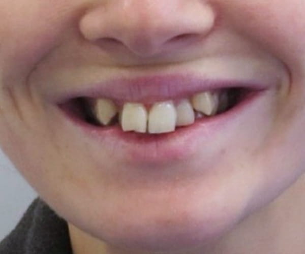 Before - Lusk Orthodontics