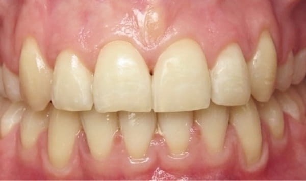 After - Lusk Orthodontics