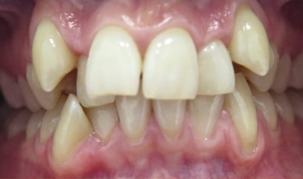Before - Lusk Orthodontics