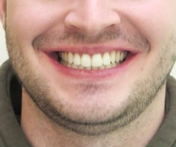 After - Lusk Orthodontics