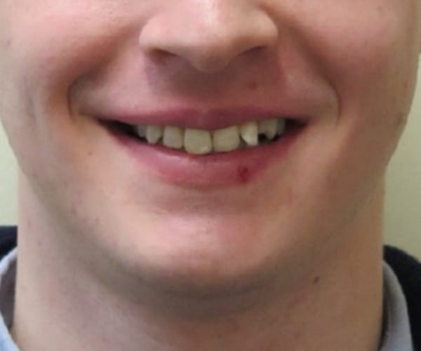 Before - Lusk Orthodontics