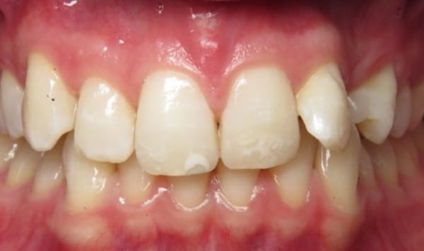 Before Lusk Orthodontics