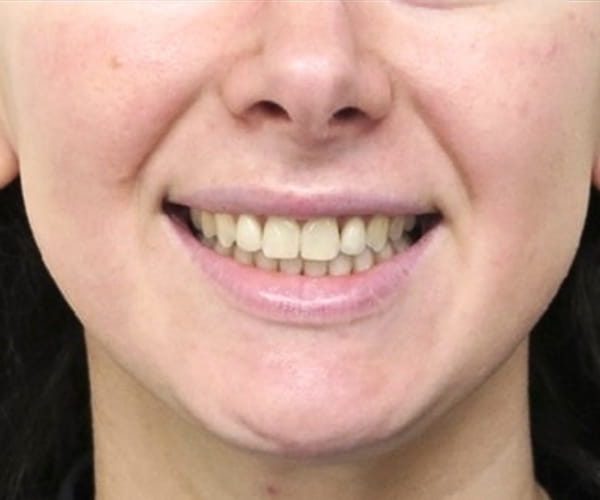 After - Lusk Orthodontics