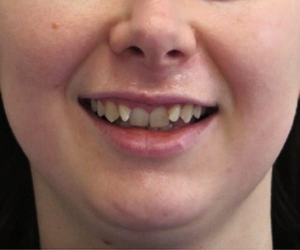 Before - Lusk Orthodontics