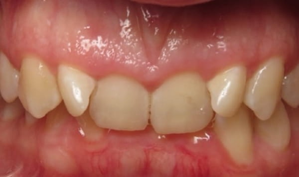 Before Lusk Orthodontics