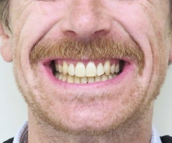 After - Lusk Orthodontics