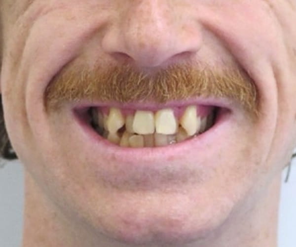 Before - Lusk Orthodontics