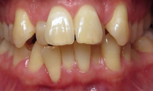 Before Lusk Orthodontics