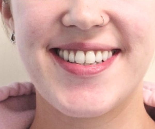 After - Lusk Orthodontics