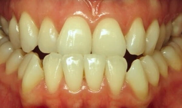 Before Lusk Orthodontics