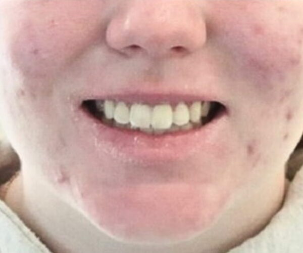 After - Lusk Orthodontics