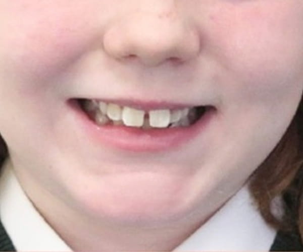 Before - Lusk Orthodontics