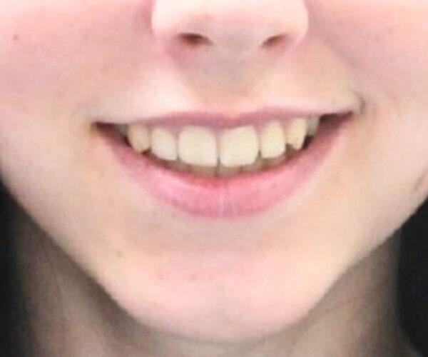 After - Lusk Orthodontics