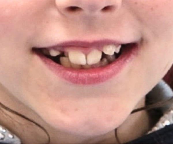 Before - Lusk Orthodontics