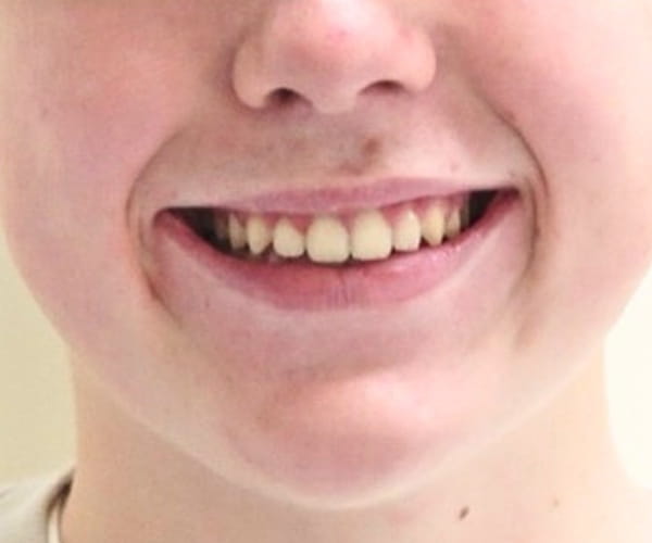 After - Lusk Orthodontics