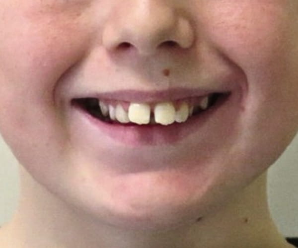 Before - Lusk Orthodontics