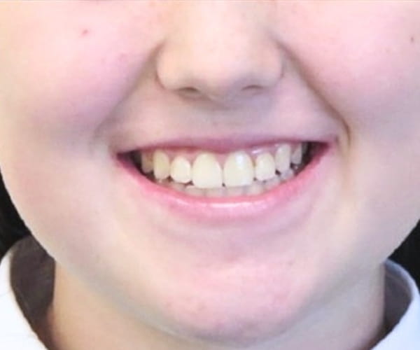 After - Lusk Orthodontics