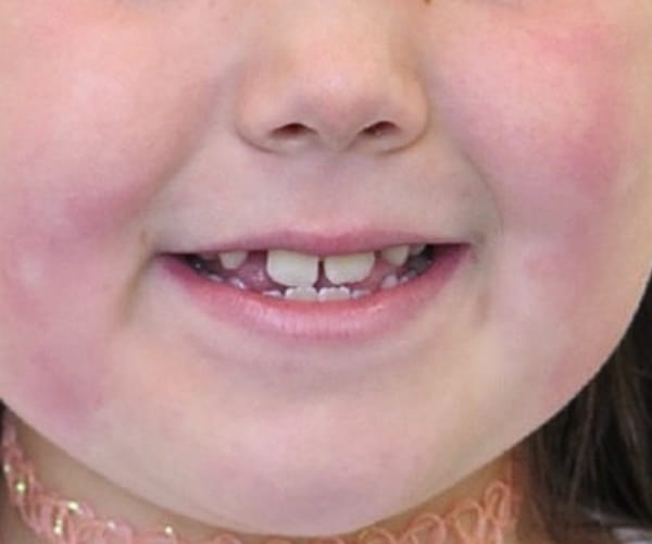 Before - Lusk Orthodontics