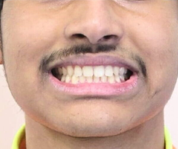 After - Lusk Orthodontics