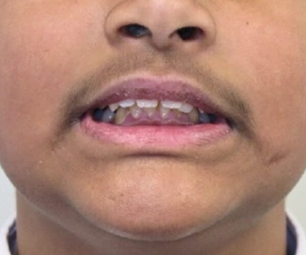 Before - Lusk Orthodontics