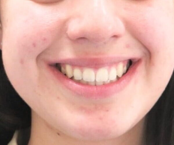 After - Lusk Orthodontics