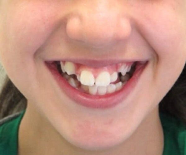Before - Lusk Orthodontics
