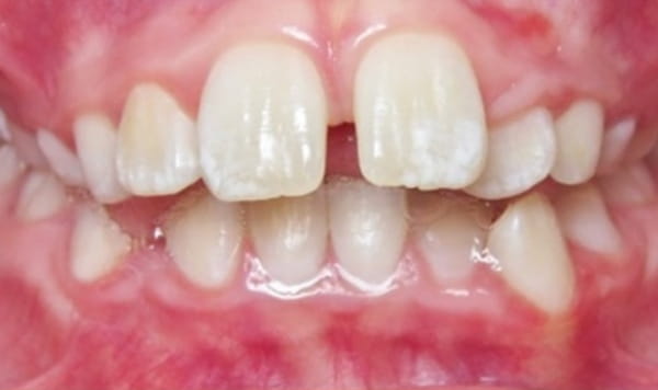 Before Lusk Orthodontics