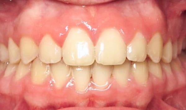 After - Lusk Orthodontics
