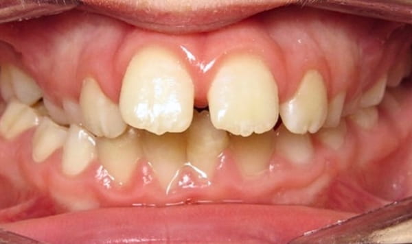 Before - Lusk Orthodontics