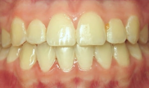After - Lusk Orthodontics