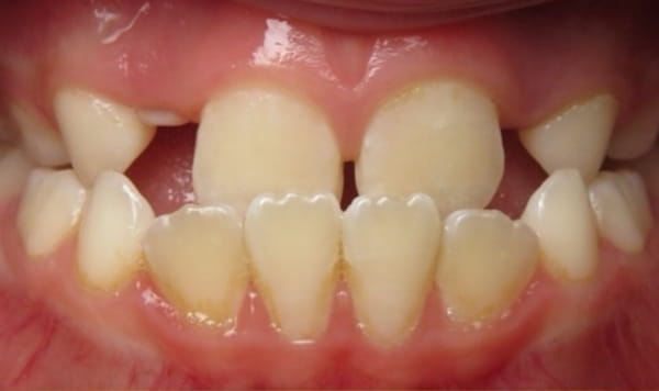 Before - Lusk Orthodontics