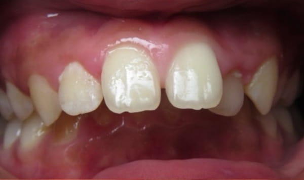 Before Lusk Orthodontics
