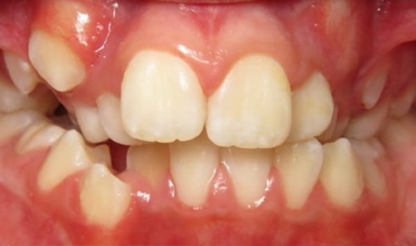 Before Lusk Orthodontics