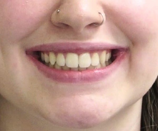 After - Lusk Orthodontics