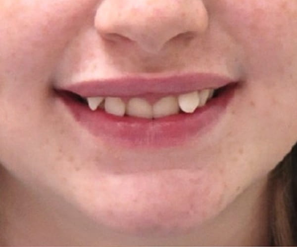 Before - Lusk Orthodontics
