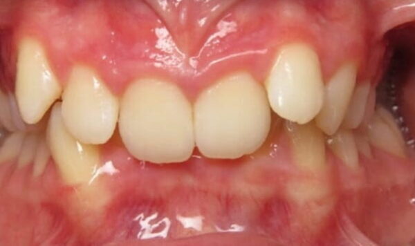 Before Lusk Orthodontics