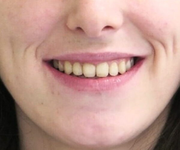 After - Lusk Orthodontics