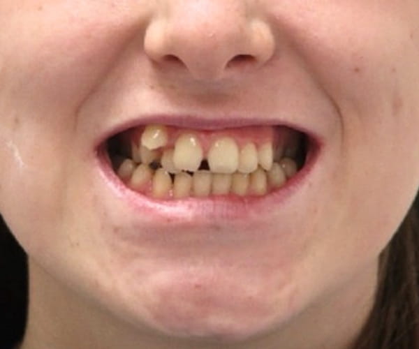 Before - Lusk Orthodontics