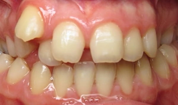 Before Lusk Orthodontics