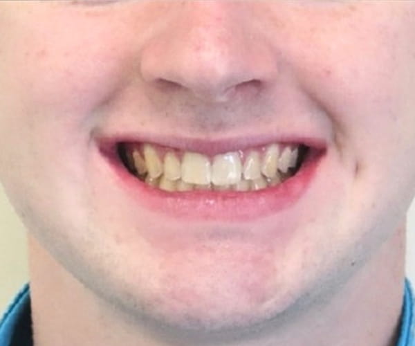 After - Lusk Orthodontics