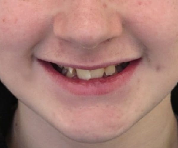Before - Lusk Orthodontics