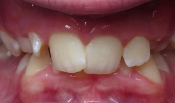 Before Lusk Orthodontics