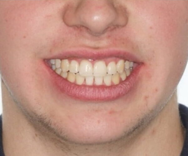 After - Lusk Orthodontics