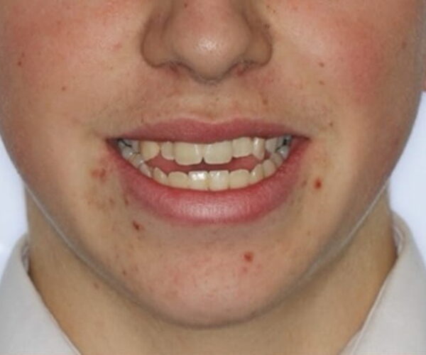 Before - Lusk Orthodontics