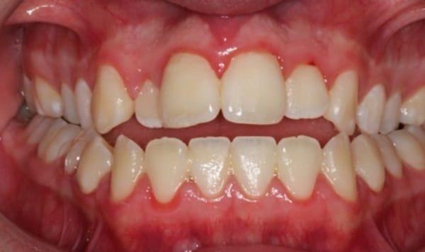Before Lusk Orthodontics