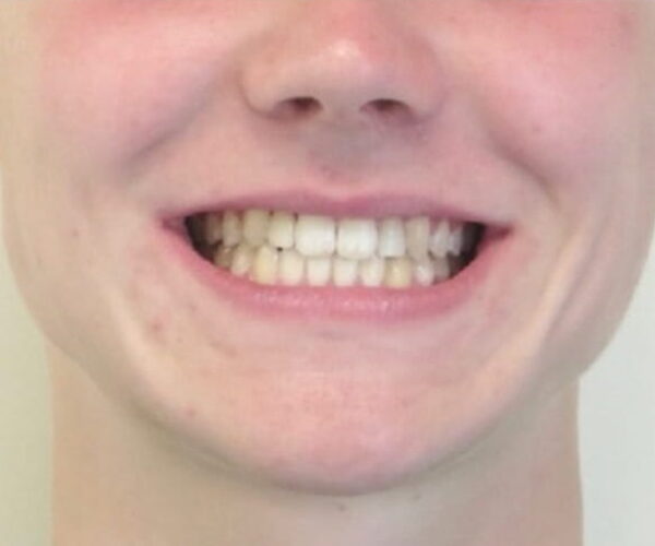 After - Lusk Orthodontics