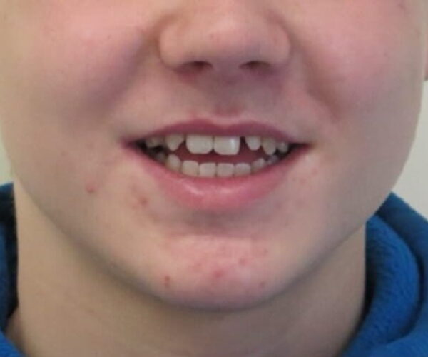 Before - Lusk Orthodontics