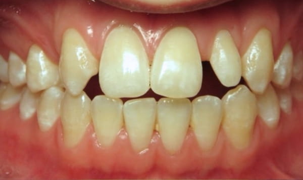 Before Lusk Orthodontics