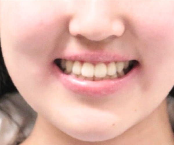 After - Lusk Orthodontics